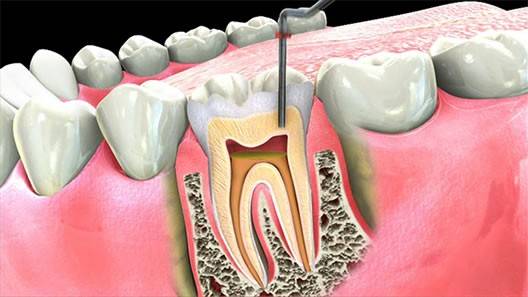 Root Canal Treatment And Exactly How Will It Allow You To?