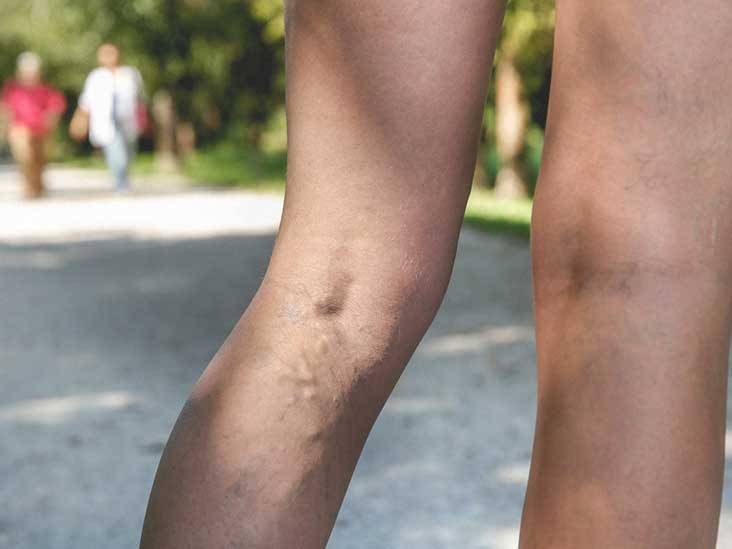 Do compression socks help prevent varicose veins?