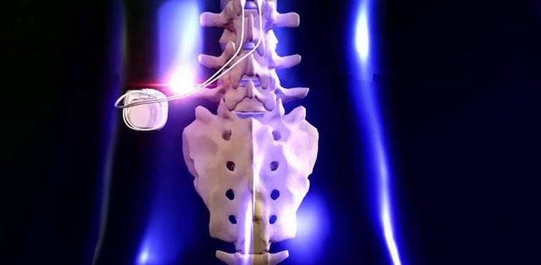 What is Spinal Cord Stimulation?