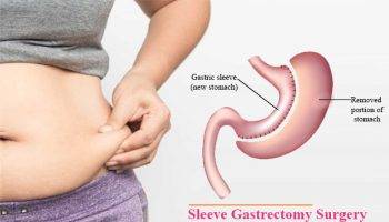 sleeve-gastrectomy-surgery-in-delhi-cusp-surgeons