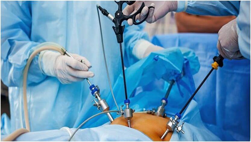 Laparoscopic Surgery: A guide