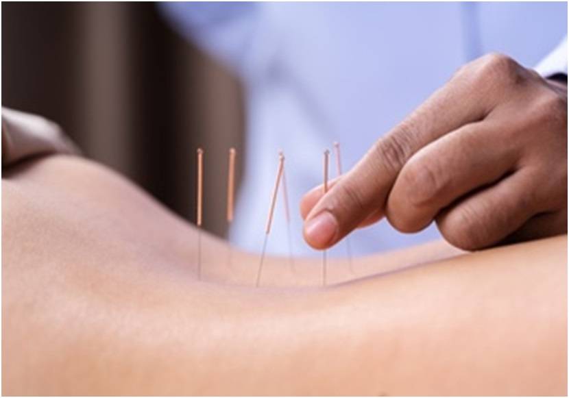 Acupuncture and acupressure: What’s the difference?