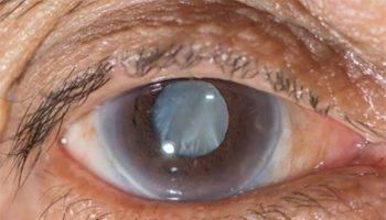7-Things-You-Need-to-Know-About-Cataract-Surgery