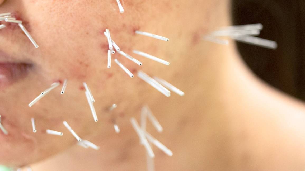 Is Acupuncture the Answer to Your Chronic Pain?