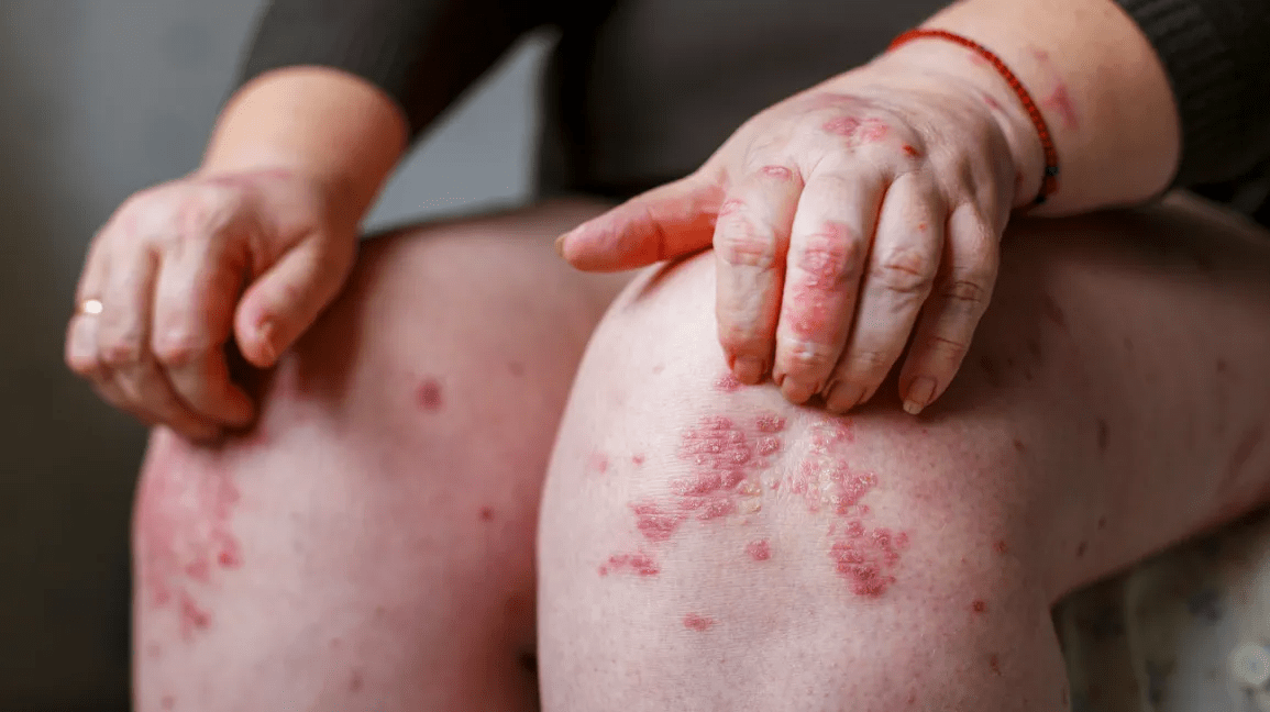Different psoriasis disease types and treatments exist